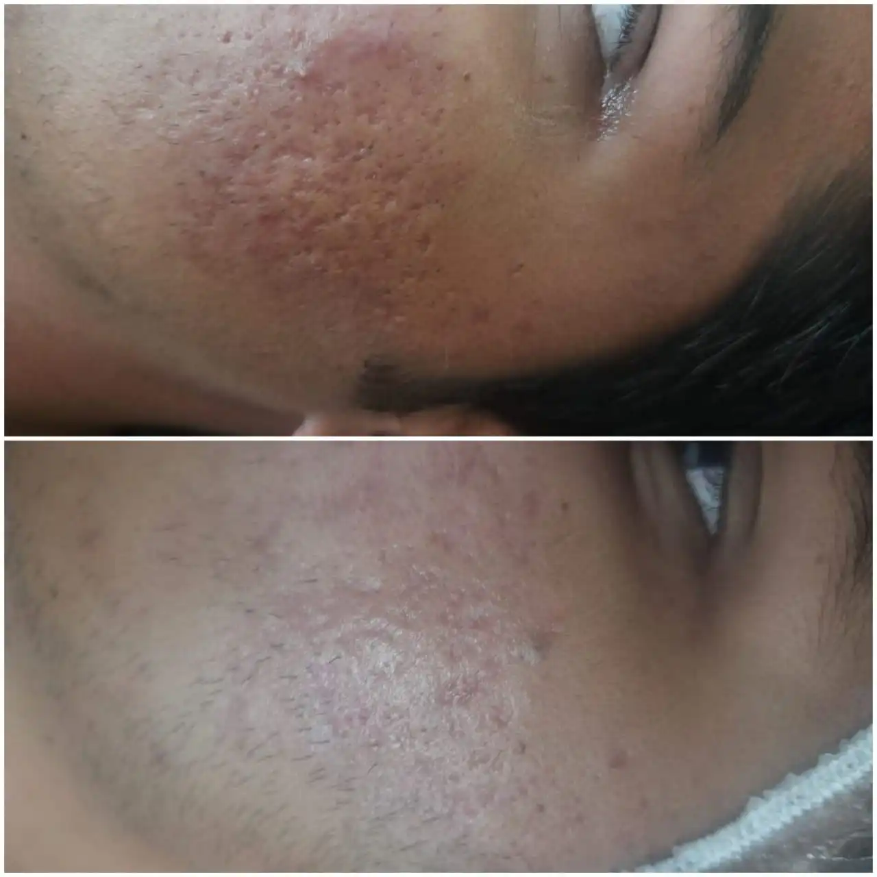 Transformative Acne Scar Treatment: TCA CROSS & Microneedling in Kota – Skinssence Clinic Kota