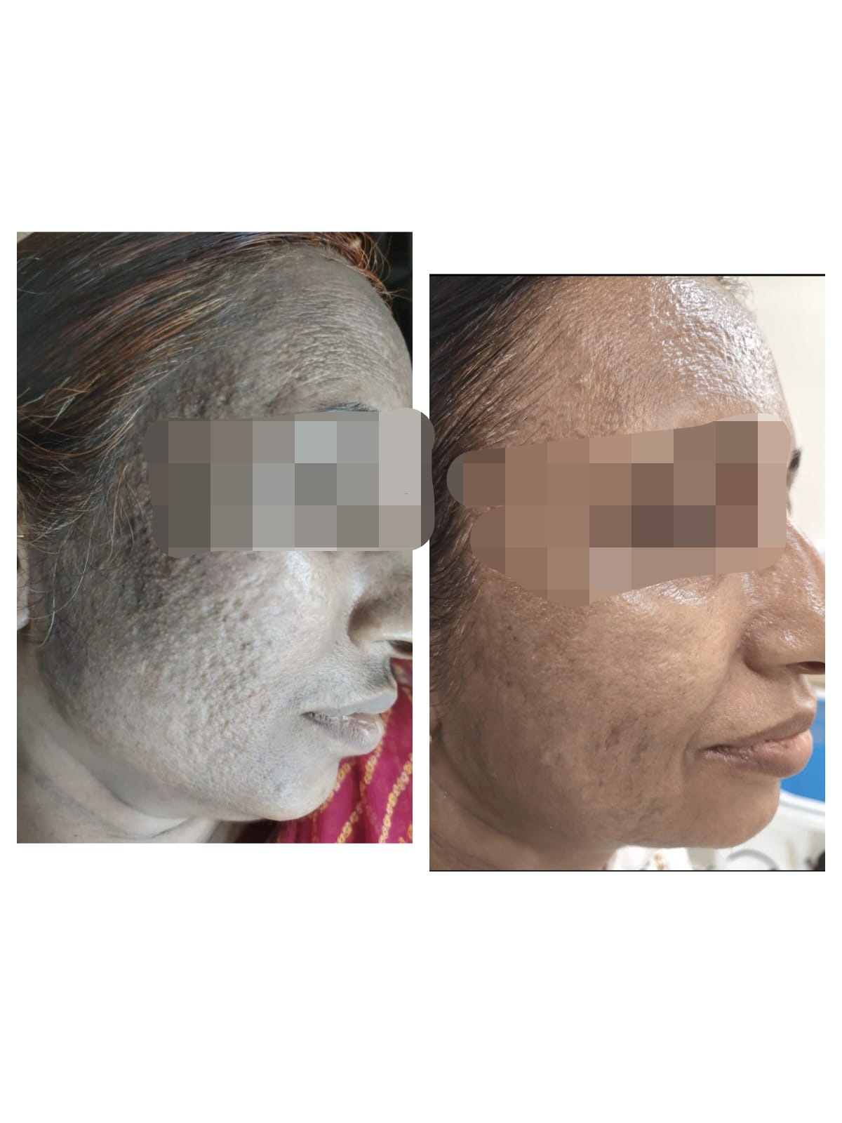A Remarkable Photographic Transformation – Skinssence Laser and Skincare Clinic Kota