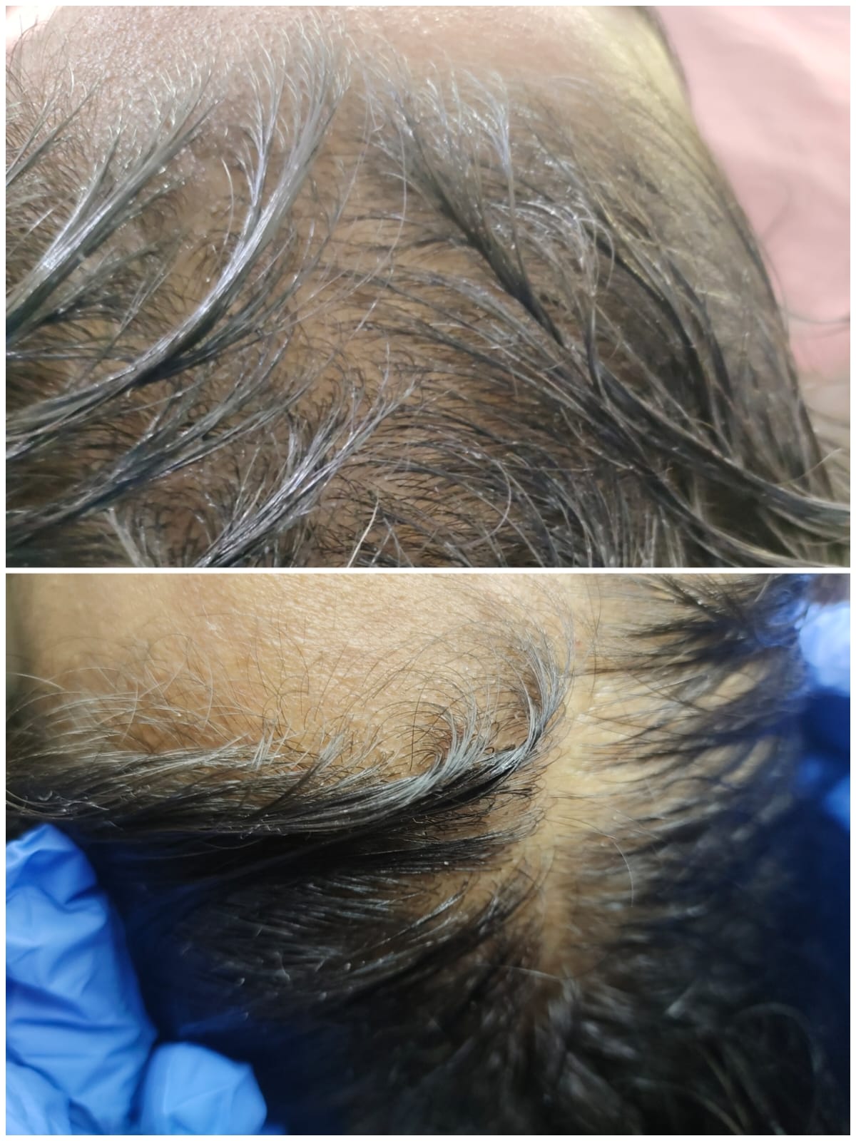 Perimenopausal Hair Loss: A Doctor-Supervised Hair Restoration Journey with Minoxidil & GFC-PRP – Skinssence Laser and Skincare Clinic Kota
