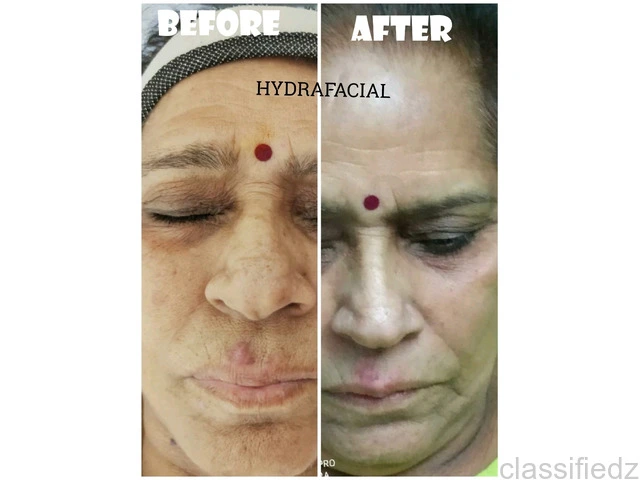 Hydrafacial Case Study for Mature Skin | Skinssence Kota – Skinssence Clinic Kota