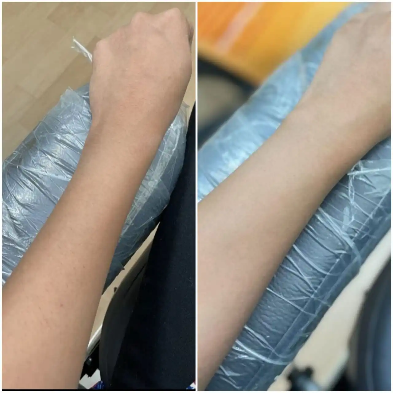 Doctor-Supervised IV Glutathione & Skin Wellness: A Clinical Case Study – Skinssence Clinic Kota