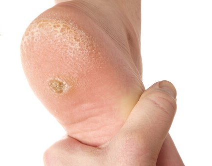 Corn Removal: A Guide to Relief and Recovery at Skinssence Laser and Skincare Clinic