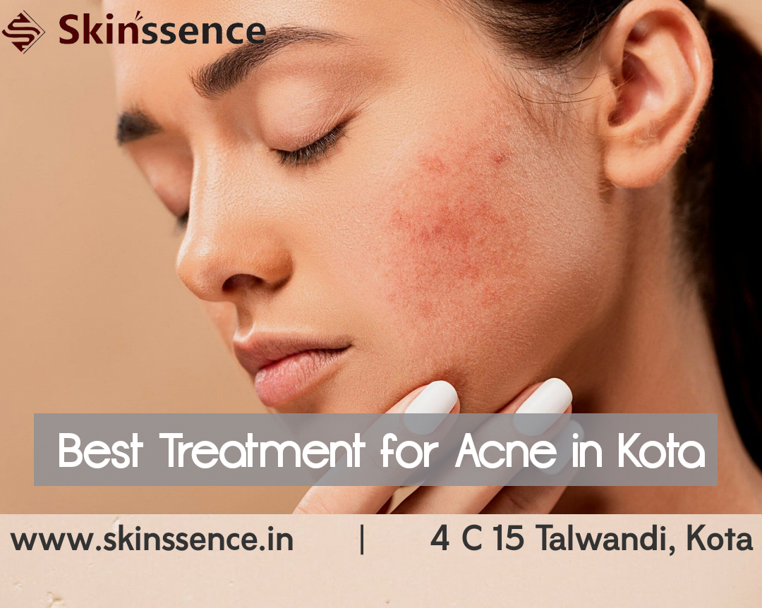 Regain Your Confidence: The Right Acne Treatment in Kota