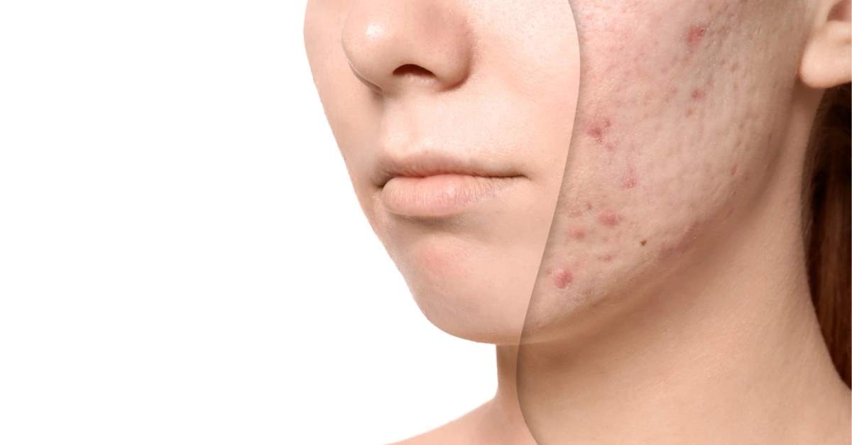 Clearing Up the Confusion: Choosing the Right Acne Scar Treatment in Kota, India