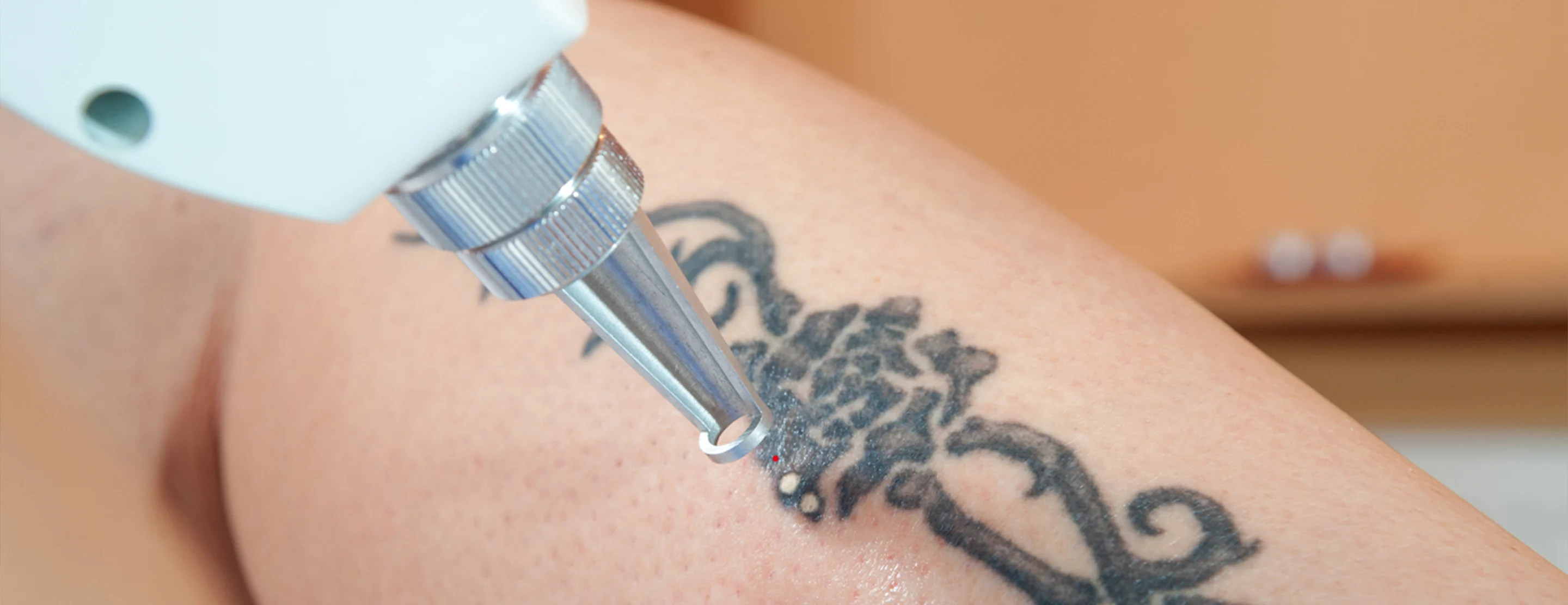 Safe & Efficient Tattoo Removal in Kota | Top Skin Doctor & Q-Switch Nd YAG Laser