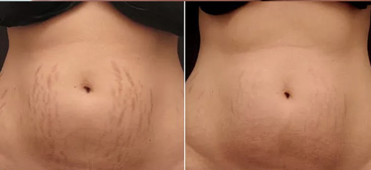 Erase Pregnancy & Stretch Marks with our Microneedling RF